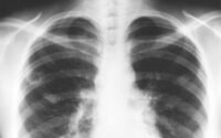gejala awal dari kanker paru