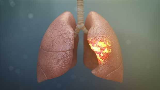penyebab penyakit paru-paru basah